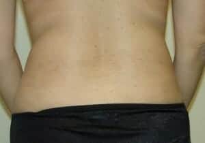 After Image: Liposuction - back