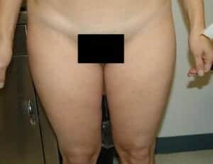 Before Image: Liposuction - front