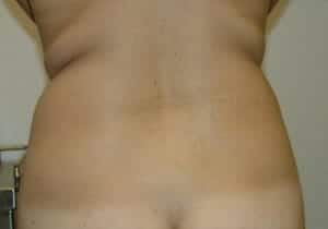 Before Image: Liposuction - back