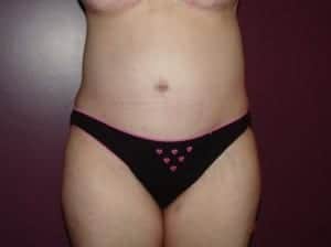 After Image: Liposuction - front