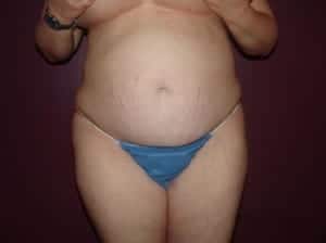 Before Image: Liposuction - front