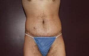 After Image: Male Tummy Tuck - front