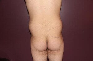 Before Image: Male Tummy Tuck - back