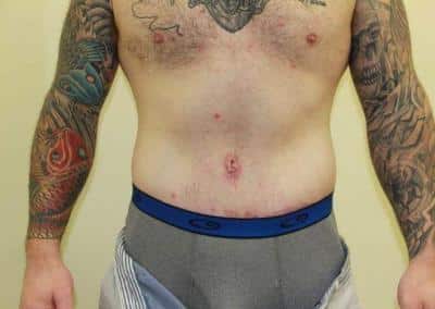 After Image: Male Tummy Tuck - front