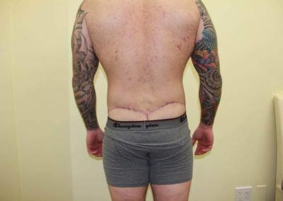 After Image: Male Tummy Tuck - back