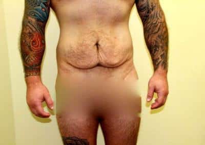 Before Image: Male Tummy Tuck - front