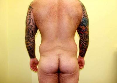 Before Image: Male Tummy Tuck - back