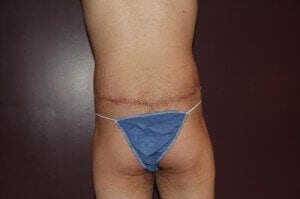 After Image: Male Tummy Tuck - back