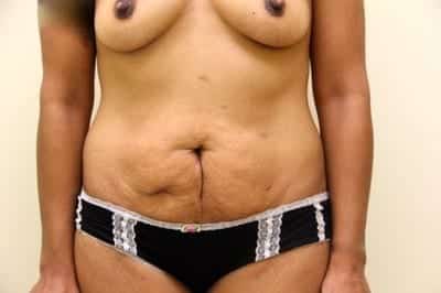 Before Image: Mommy Makeover - front