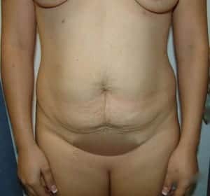 Before Image: Mommy Makeover - front