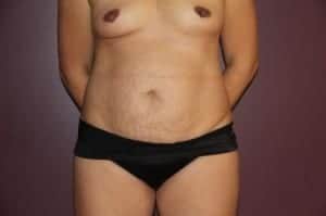 Before Image: Mommy Makeover - front