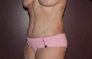 After Image: Mommy Makeover - left-front-oblique