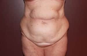 Before Image: Mommy Makeover - front