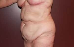 Before Image: Mommy Makeover - left-front-oblique