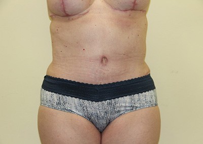After Image: Mommy Makeover - front