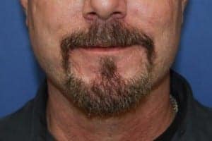 After Image: Neck Lift - front