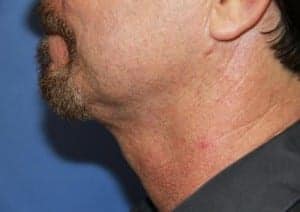 After Image: Neck Lift - left-front-oblique