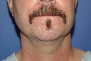 Before Image: Neck Lift - front