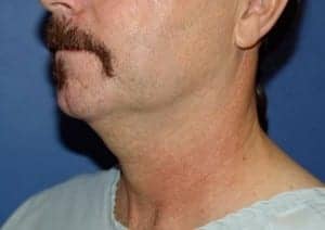 Before Image: Neck Lift - left-front-oblique