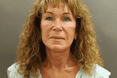 After Image: Neck Lift - front