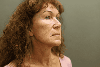 Before Image: Neck Lift - right-front-oblique