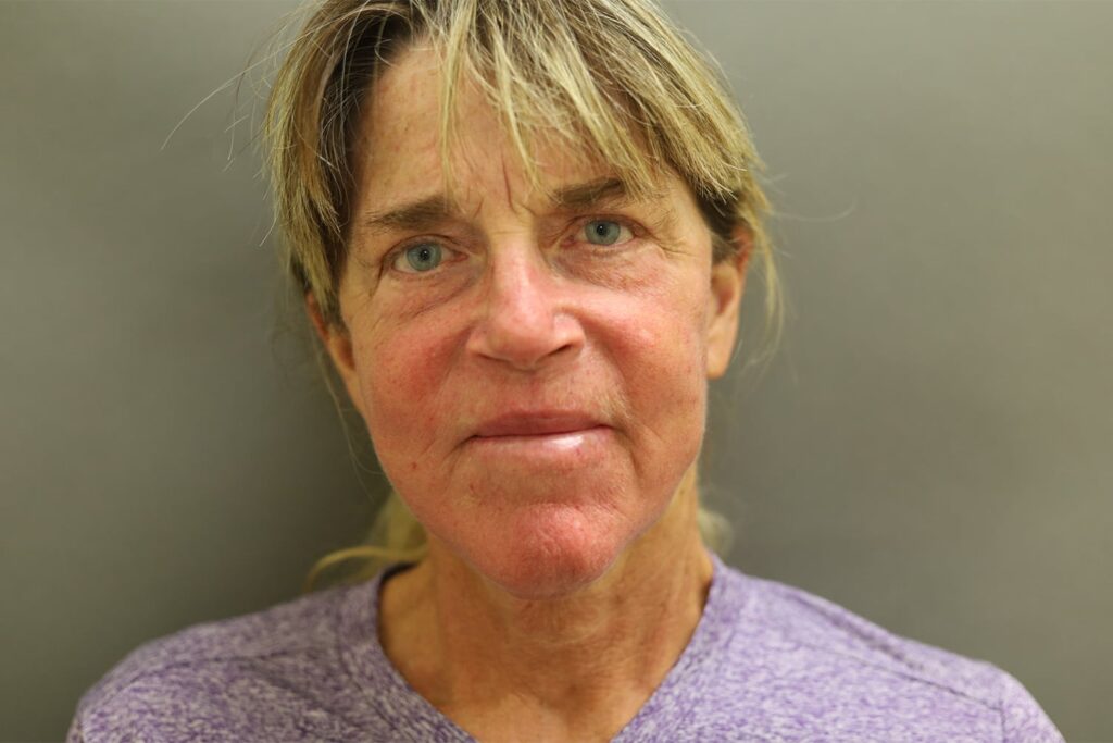 After Image: Neck Lift - front