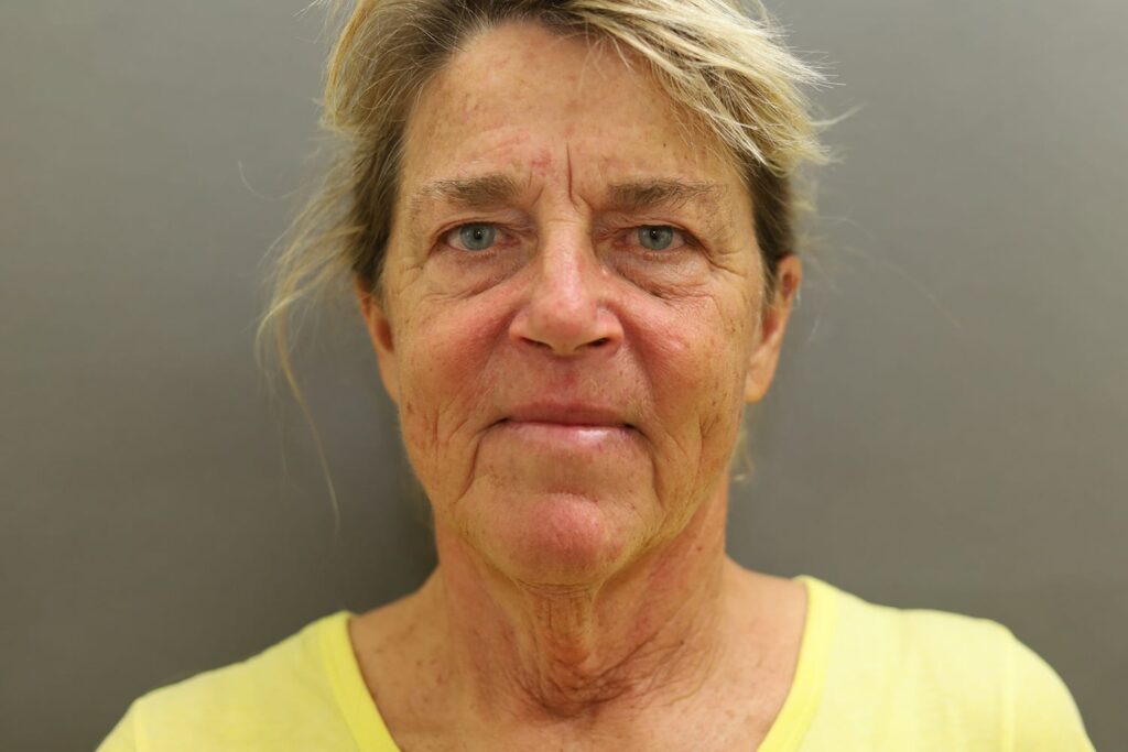 Before Image: Neck Lift - front