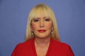 After Image: Neck Lift - front