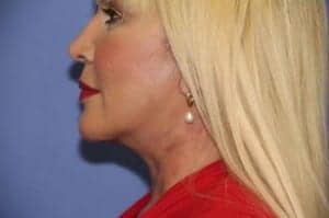 After Image: Neck Lift - left-side