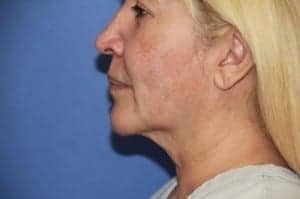 Before Image: Neck Lift - left-side