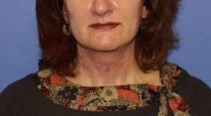 After Image: Neck Lift - front