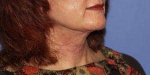After Image: Neck Lift - right-front-oblique