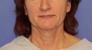 Before Image: Neck Lift - front