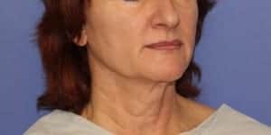 Before Image: Neck Lift - right-front-oblique