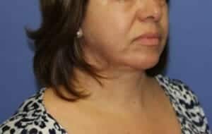After Image: Neck Lift - front