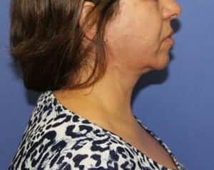 After Image: Neck Lift - right-side