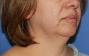 Before Image: Neck Lift - front