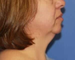 Before Image: Neck Lift - right-side