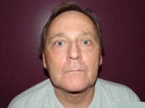 After Image: Neck Lift - front