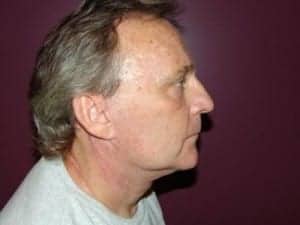 After Image: Neck Lift - front