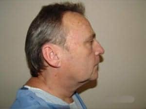 Before Image: Neck Lift - front
