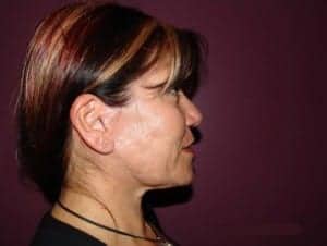 After Image: Neck Lift - right-side