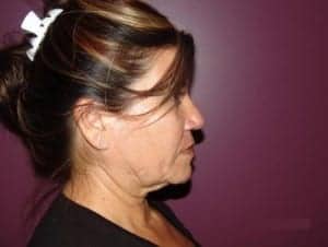 Before Image: Neck Lift - right-side