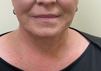 After Image: Neck Lift - front