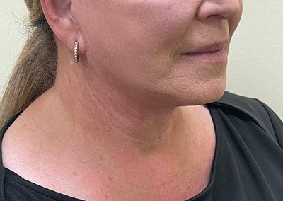 After Image: Neck Lift - right-front-oblique