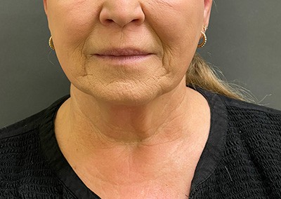 Before Image: Neck Lift - front
