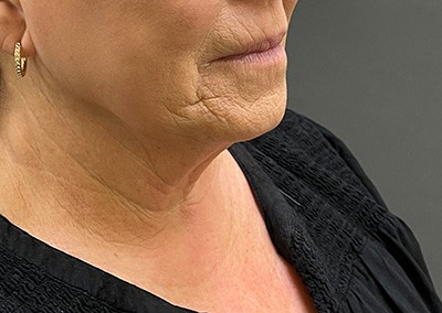 Before Image: Neck Lift - right-front-oblique
