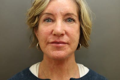 After Image: Neck Lift - front