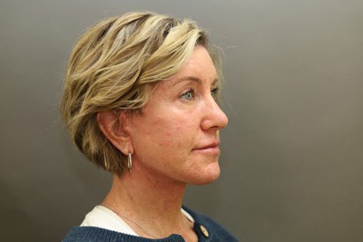 After Image: Neck Lift - right-front-oblique