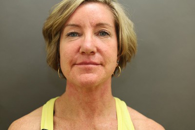 Before Image: Neck Lift - front
